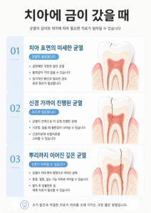 치아에 금이 간 경우에 대한 치료법을 설명하는 이미지