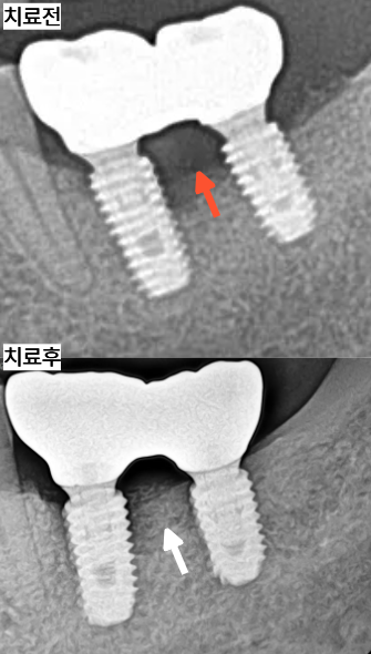 임플란트염증,임플란트 주위염