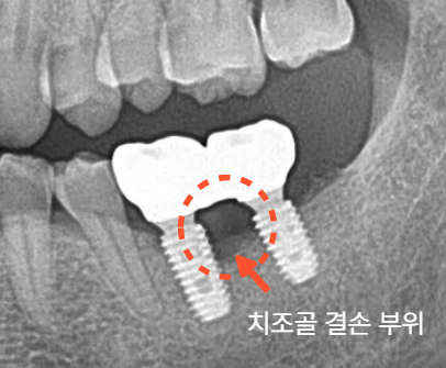 임플란트염증,임플란트 주위염