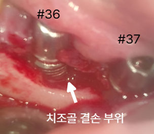 임플란트염증,임플란트 주위염