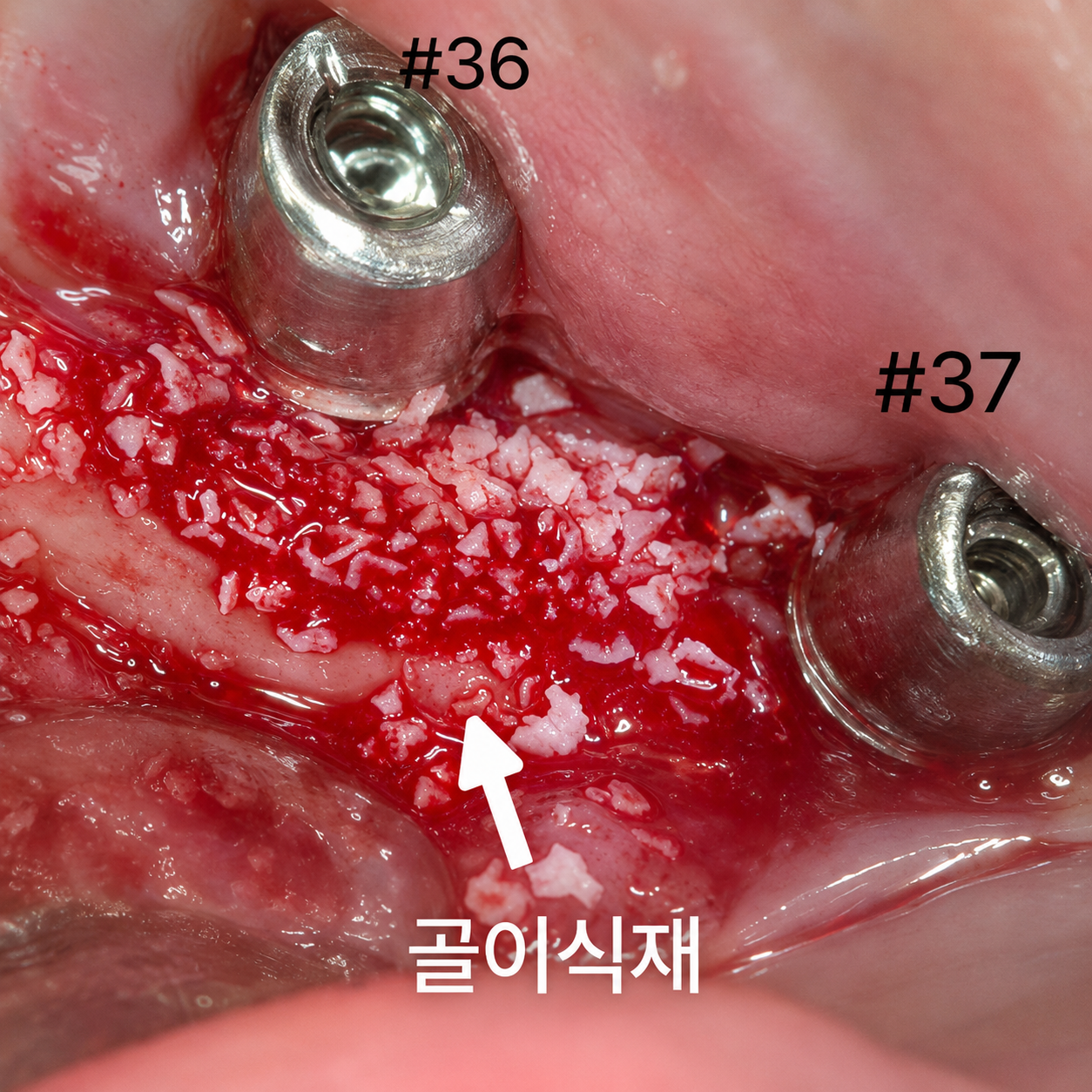 임플란트염증,임플란트 주위염