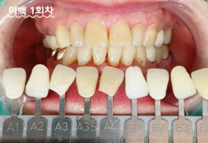 치아미백