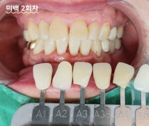 치아미백