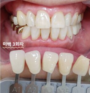 치아미백