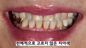 치아미백