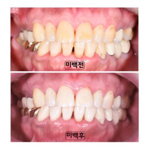 치아미백
