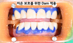 치아미백