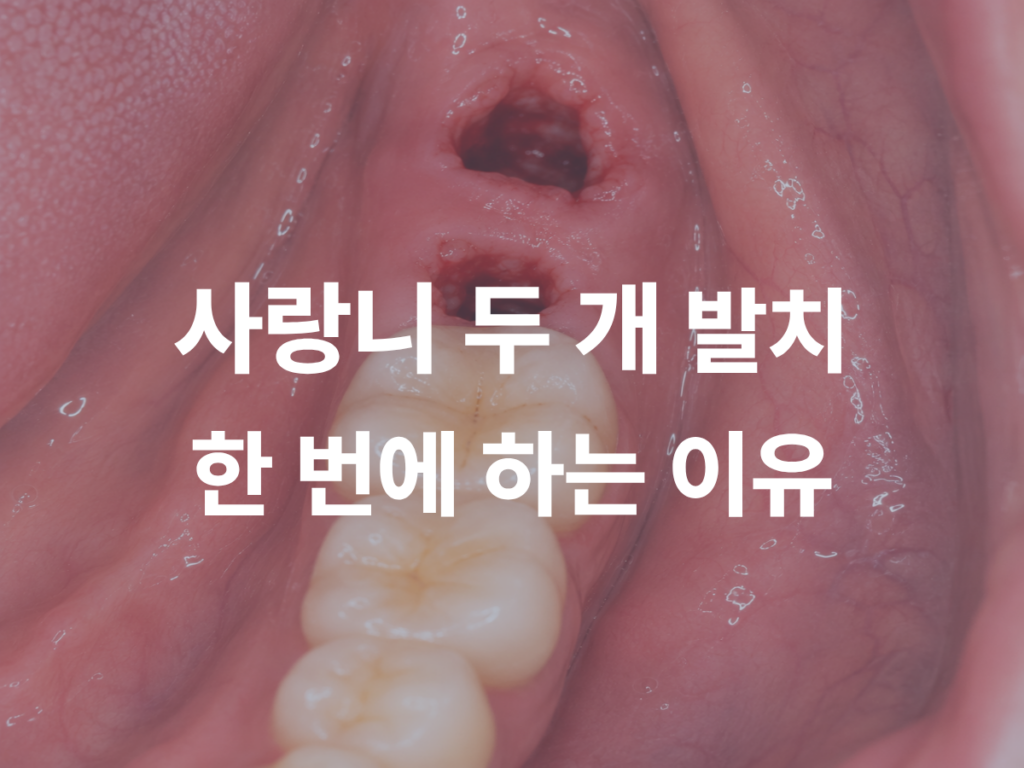 사랑니 두 개, 따로 뽑을까 한 번에 뽑을까?
