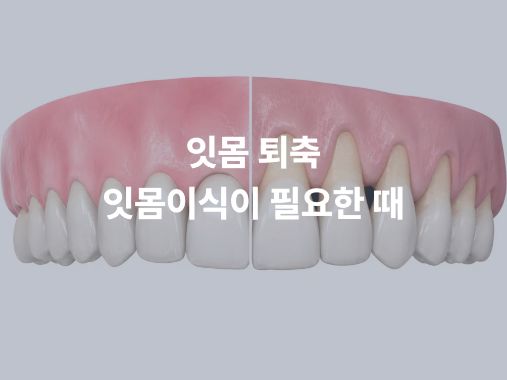 잇몸이 내려앉는 이유, 잇몸이식은 언제 필요할까요?