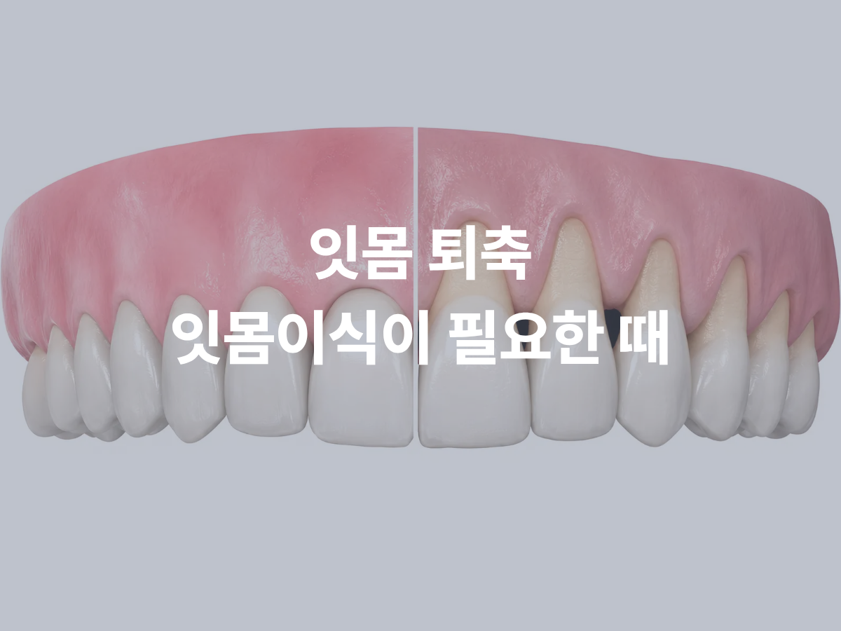 잇몸이 내려앉는 이유, 잇몸이식은 언제 필요할까요?
