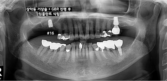 상악동 거상술과 골이식을 동반한 16번 임플란트 식립 후 파노라마 사진