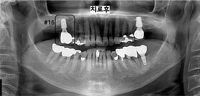 16번 임플란트 최종 보철물 장착 후 파노라마 사진