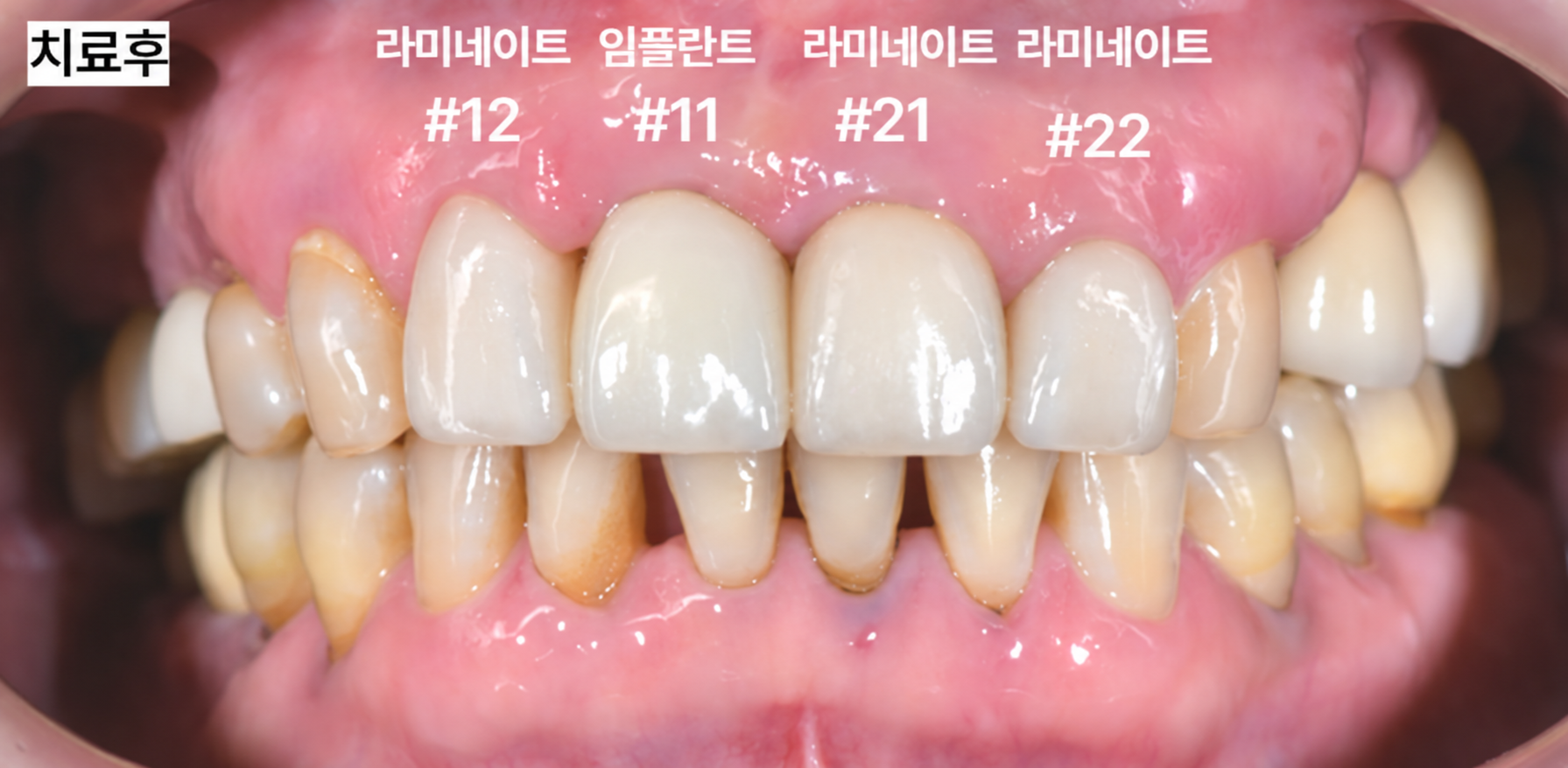 치료 후 임플란트와 라미네이트를 적용한 앞니 전체 배열