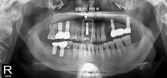 앞니 임플란트 식립 후 파노라마 사진