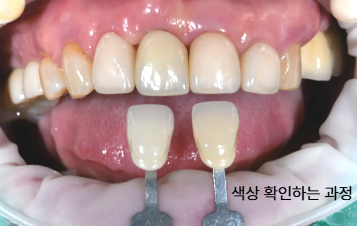 색상표를 대고 앞니 보철물과 라미네이트의 색조를 확인하는 과정