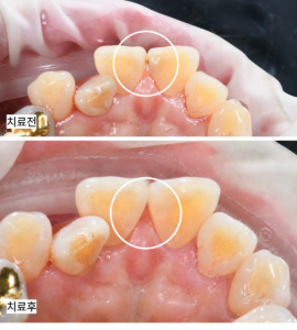 #11,12 치아의 인접면 충치를 레진으로 치료한 전 후 비교 사진